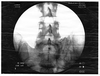 NOT disabled ???, proving point, spine, xray, verterbrae, hip, disc, sacral region, flouroscopy HD wallpaper
