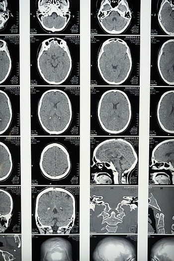 Comprehensive set of brain MRI scans highlighting cranial anatomy for medical use. HD phone wallpaper