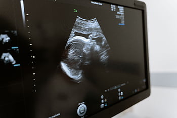 Close-up of an ultrasound showing a fetus on a monitor in a medical clinic. HD wallpaper