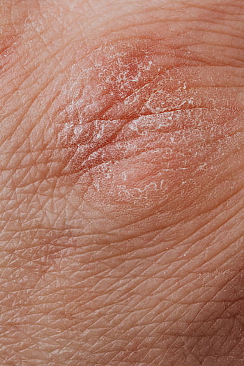 Detailed highlighting dry, flaky skin texture for dermatological study. HD phone wallpaper