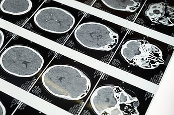 Detailed brain MRI scans displayed on a lightbox, showcasing medical imaging techniques. HD wallpaper