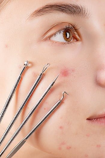 Close-up of skincare tools on acne-affected skin for dermatological treatment. HD phone wallpaper