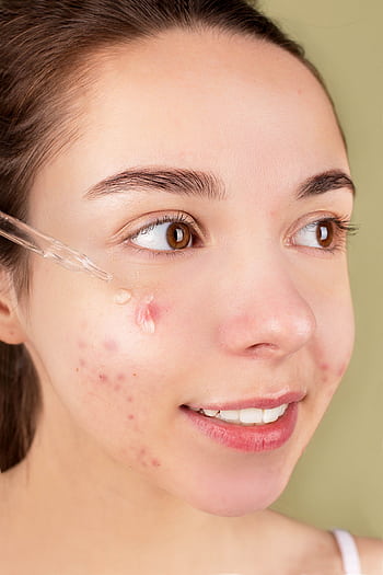 Close-up of a young woman applying serum on her face for acne treatment and skincare routine. HD phone wallpaper