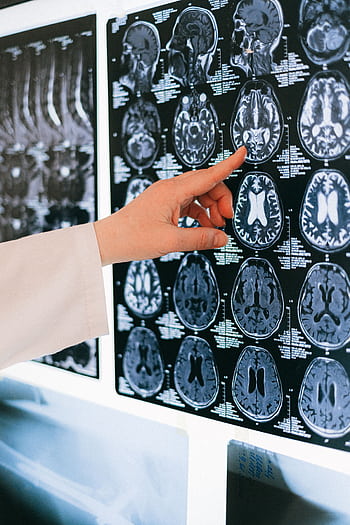 A doctor's hand points to a brain MRI scan on a lightbox, illustrating medical diagnosis. HD phone wallpaper