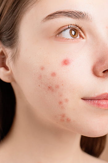 A detailed close-up of a woman's face showing acne blemishes on her skin. HD phone wallpaper