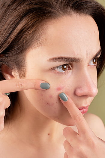 Close-up of a young woman treating her acne-prone skin. HD phone wallpaper