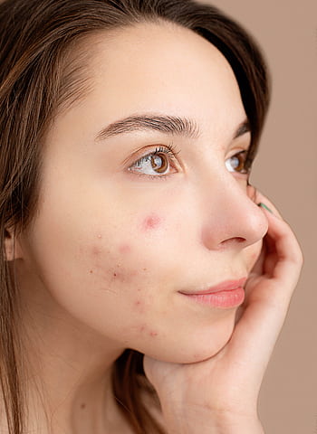 Close-up portrait of a young woman with acne, hand on face, pensive expression. HD phone wallpaper
