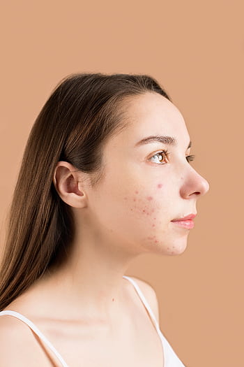 Close-up profile portrait of a teenage girl with acne against a neutral background. HD phone wallpaper
