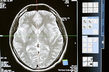 Intricate MRI brain scan displayed on a computer screen for medical analysis and diagnosis. HD wallpaper