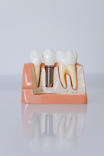 Detailed view of a dental implant model showcasing teeth and gum anatomy for dental education. HD phone wallpaper