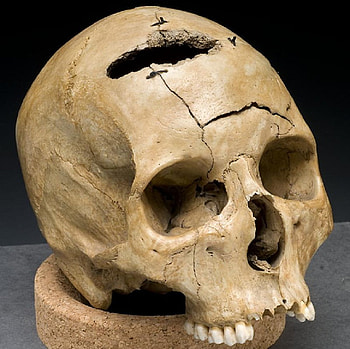 Gunshot Trauma, Civil War Era, abstract, graphy, trauma, skull, damage, gunshot victim HD wallpaper