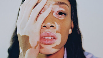 Winnie Harlow, Body, Canadian girl HD wallpaper